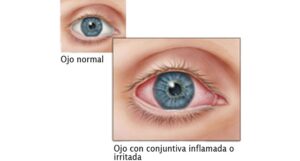 recomendaciones prevenir conjuntivitis SESA